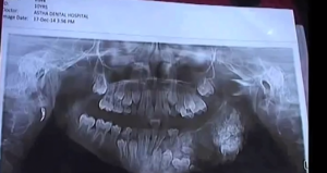ylimääräiset-hampaat