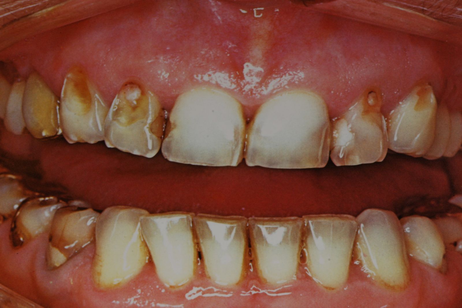 hapon-kuluttamat-hampaat