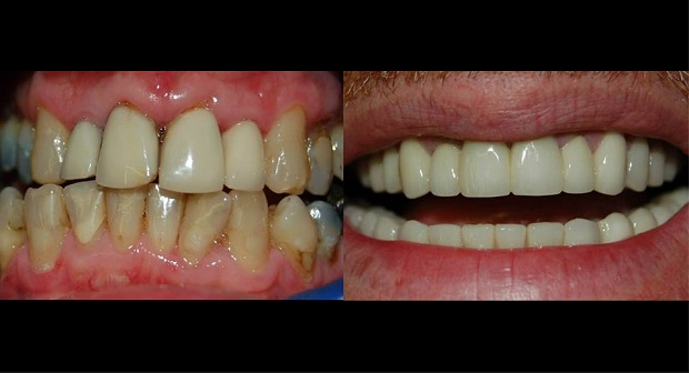 hampaat-studiodent-ennen-jälkeen
