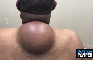 dr-pimple-popper-lipooma