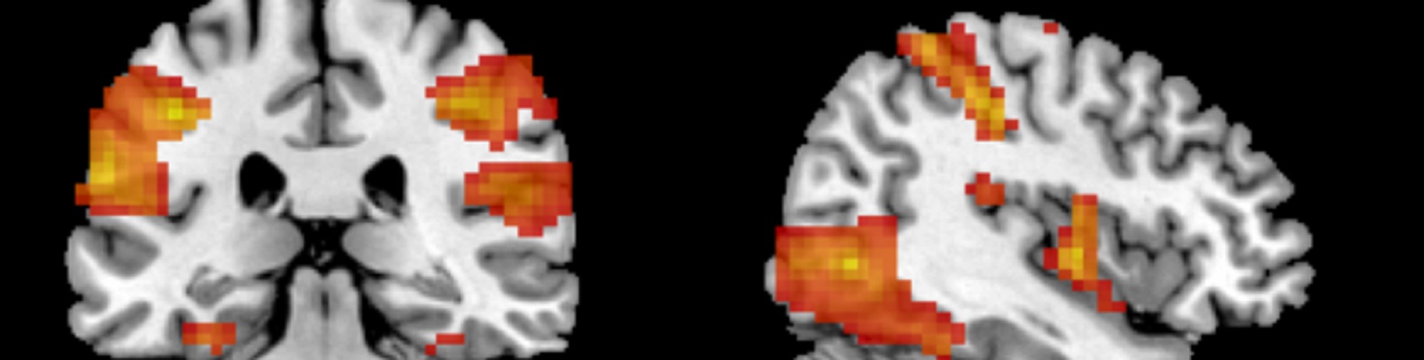 aivot-magneettikuva-crps