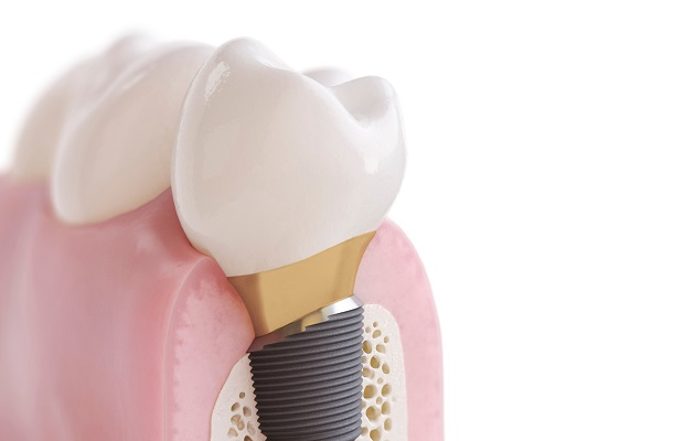hammas-implantti-keinojuuri
