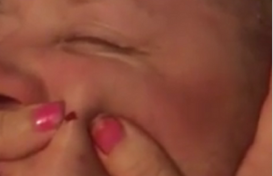 nainen puhkaisee finnin