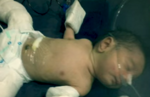 vauva parasiittisikiö