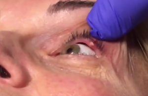 naisen silmä lääkäri