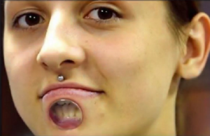 venytetty lävistys alahuulessa