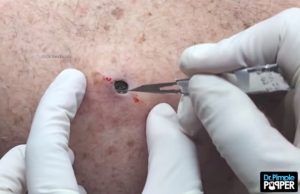 dr-pimple-popper-mustapää