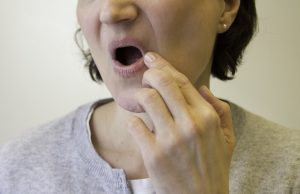 nainen-suu-kuiva-halkeilu-kuva-oral-hammaslääkärit