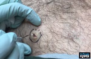 mustapää-youtube-dr-pimple-popper